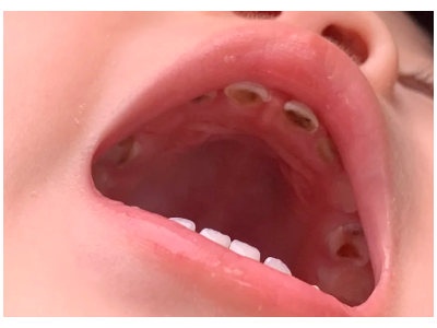 河北惟德口腔涂氟流程簡(jiǎn)單，孩子配合度拉滿(mǎn)