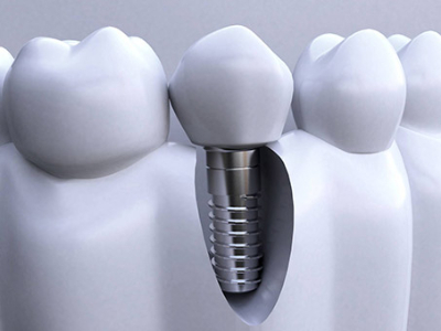 承德種植牙價(jià)格表，2024種植牙多少錢一顆呢?