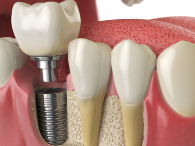 選擇種植牙后要做哪些日常維護(hù)？