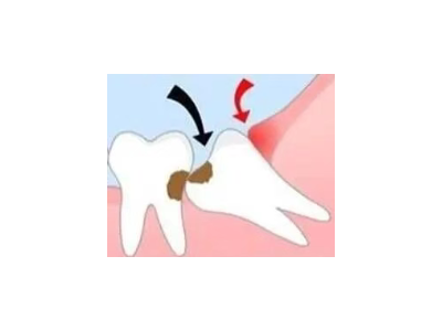 吃完飯后老塞牙？別大意！這可能是你的牙齒在報(bào)警