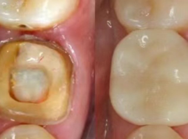 根管治療（抽神經(jīng)）后，為什么一定要做牙冠？