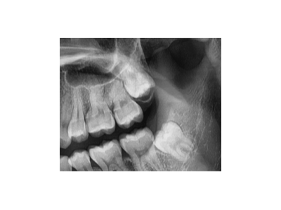 既然「智齒」不宜久留，為什么不能一次性拔掉？