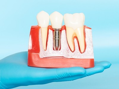 種牙VS鑲牙，你適合哪種?