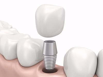 在承德哪家口腔醫(yī)院口腔種植齒好一點(diǎn)，惟德口腔醫(yī)院值得您的選擇