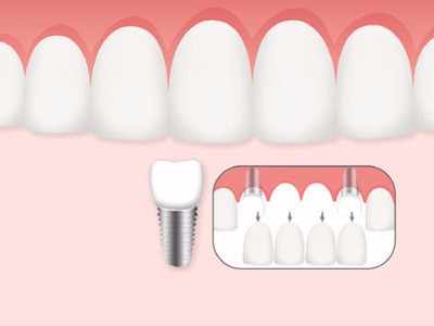 惟德口腔口腔種植怎么樣？惟德口腔就來(lái)為您一一解答