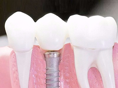 在承德口腔種植齒需要多少錢？惟德口腔一一為您道來(lái)