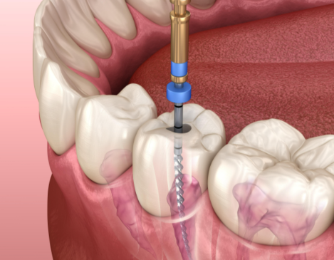 根管治療后的注意事項(xiàng)有哪些？