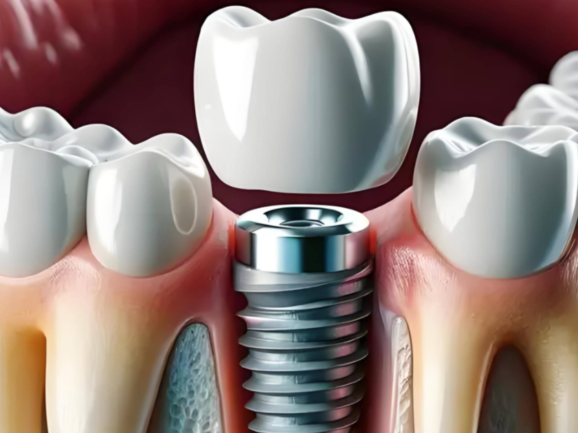 對于老年人來說，裝假牙和種植牙哪個更好